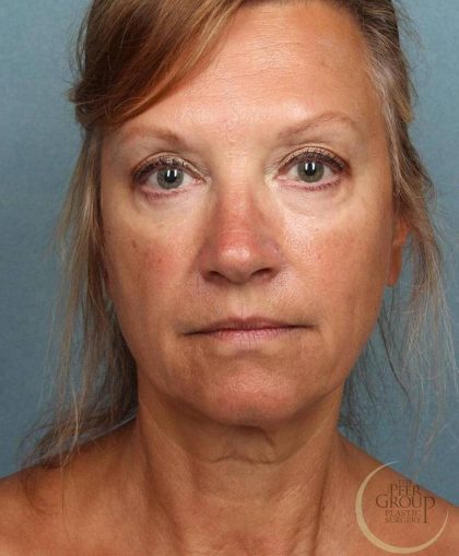 Juvederm Vollure Before & After Patient #9074