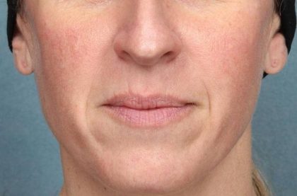 Juvederm Vollure Before & After Patient #9081