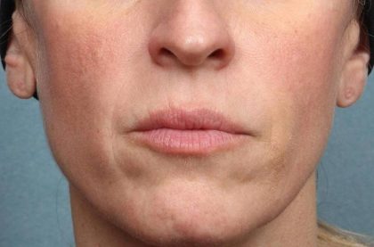 Juvederm Vollure Before & After Patient #9081