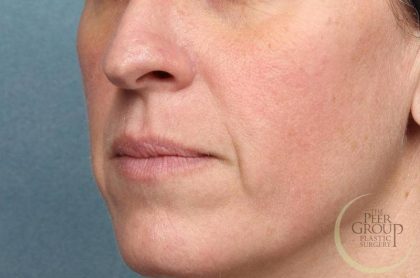 Juvederm Vollure Before & After Patient #9081
