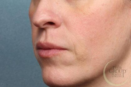 Juvederm Vollure Before & After Patient #9081