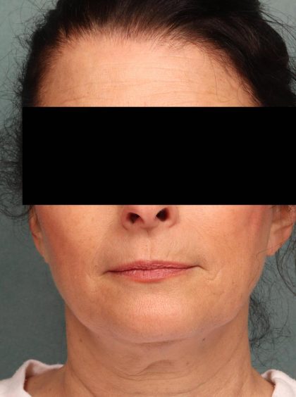 Juvederm Before & After Patient #9111