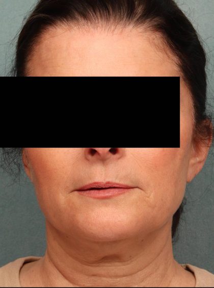 Juvederm Before & After Patient #9111