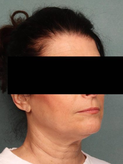 Juvederm Before & After Patient #9111