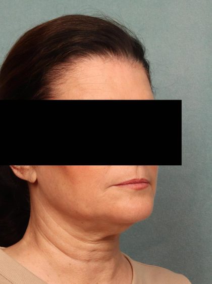 Juvederm Before & After Patient #9111