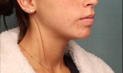 Juvederm Before & After Patient #9112