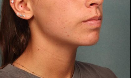 Juvederm Before & After Patient #9112