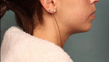Juvederm Before & After Patient #9112