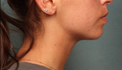 Juvederm Before & After Patient #9112