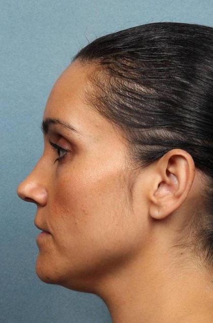 Kybella Before & After Patient #9089