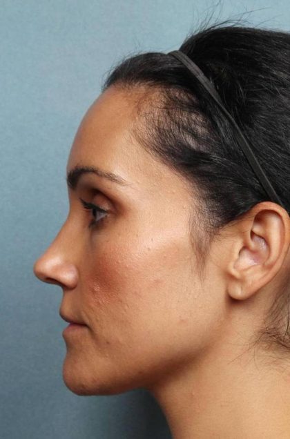 Kybella Before & After Patient #9089
