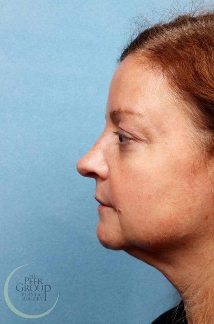 Kybella Before & After Patient #9090