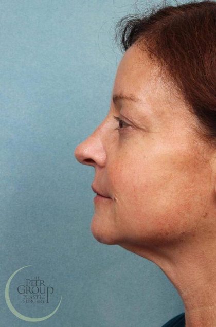 Kybella Before & After Patient #9090