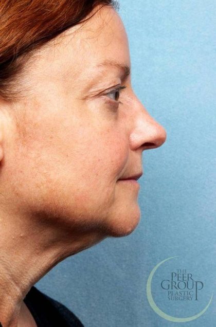 Kybella Before & After Patient #9090