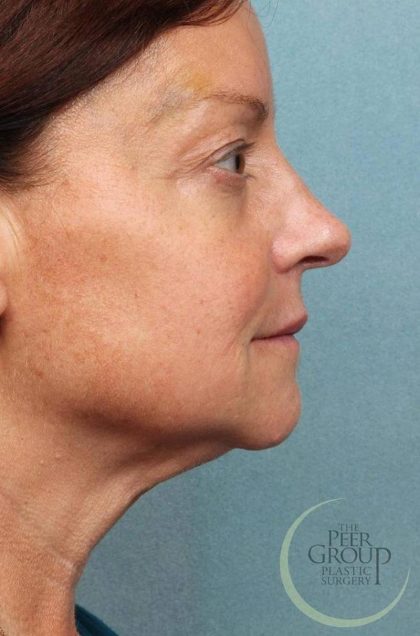 Kybella Before & After Patient #9090