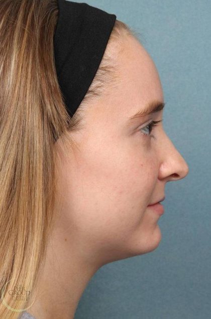 Kybella Before & After Patient #9091