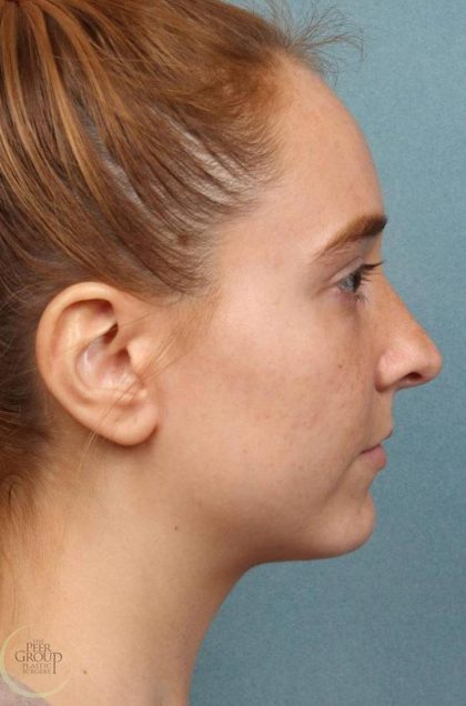Kybella Before & After Patient #9091