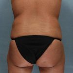 Liposuction Before & After Patient #9129