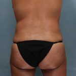 Liposuction Before & After Patient #9129
