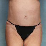Liposuction Before & After Patient #9133