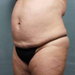 Liposuction Before & After Patient #9133