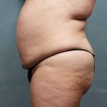 Liposuction Before & After Patient #9133