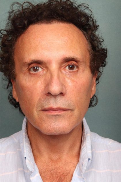Neck Lift Before & After Patient #9198