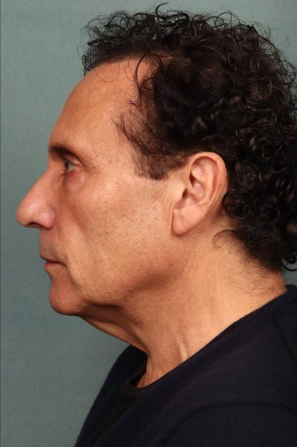 Neck Lift Before & After Patient #9198