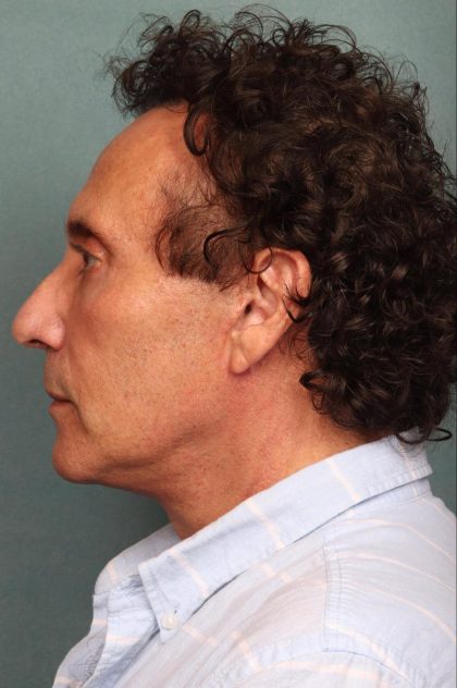 Neck Lift Before & After Patient #9198