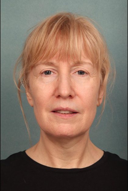 Neck Lift Before & After Patient #9199