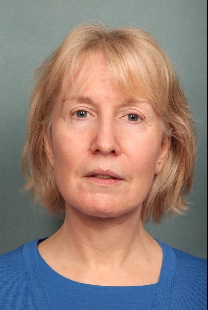 Neck Lift Before & After Patient #9199