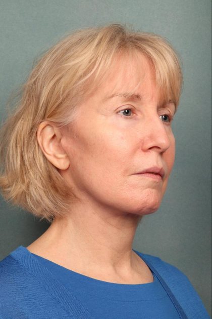 Neck Lift Before & After Patient #9199