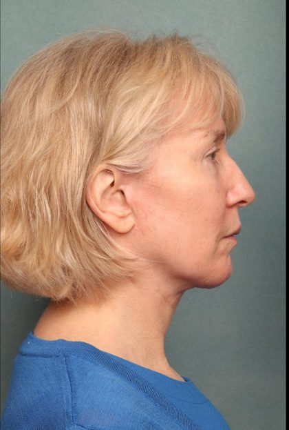 Neck Lift Before & After Patient #9199