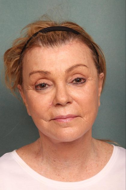 Neck Lift Before & After Patient #9200