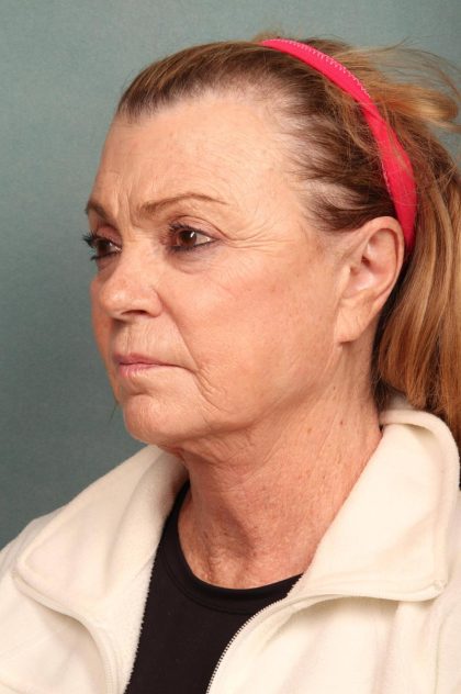 Neck Lift Before & After Patient #9200