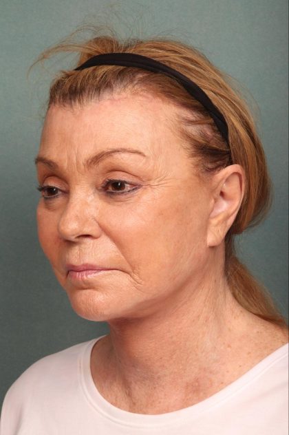 Neck Lift Before & After Patient #9200