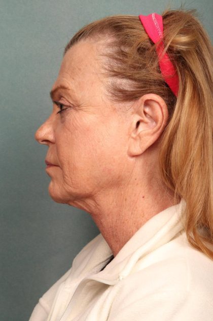 Neck Lift Before & After Patient #9200