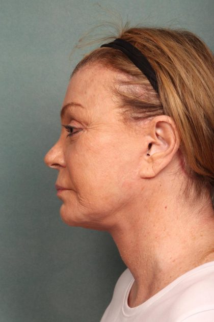 Neck Lift Before & After Patient #9200