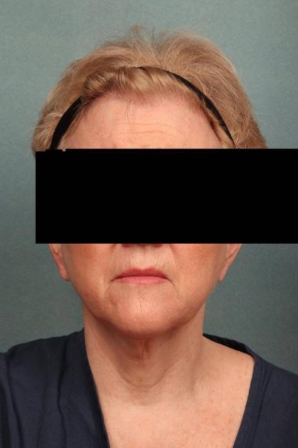 Neck Lift Before & After Patient #9202