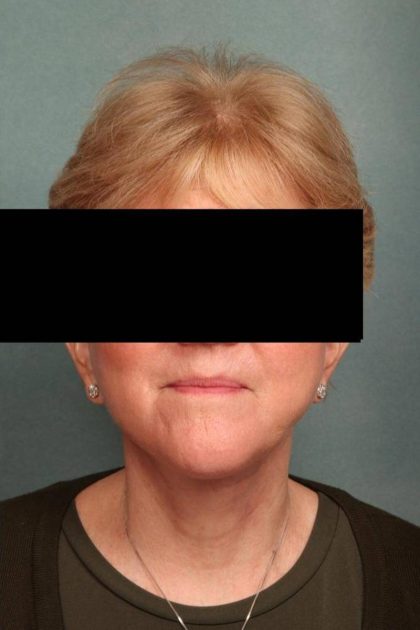 Neck Lift Before & After Patient #9202