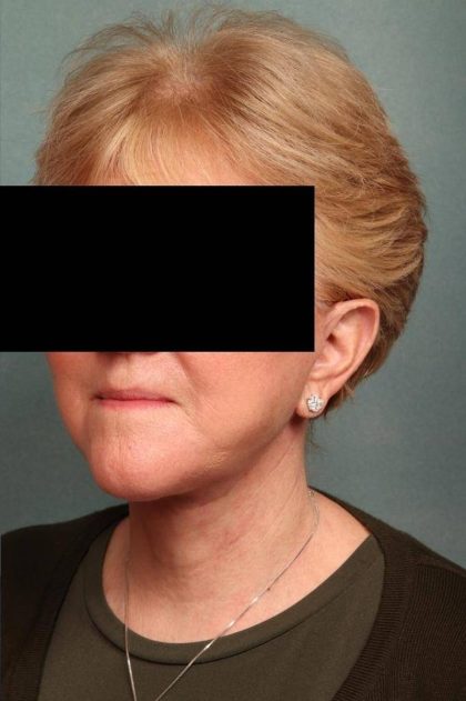 Neck Lift Before & After Patient #9202