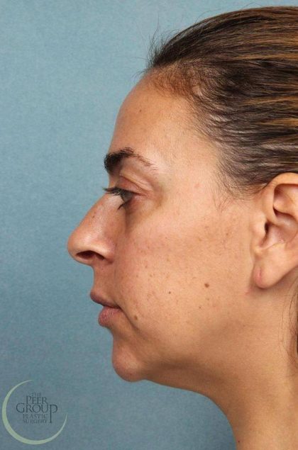 Rhinoplasty Before & After Patient #9214