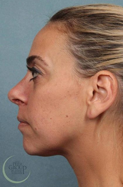 Rhinoplasty Before & After Patient #9214
