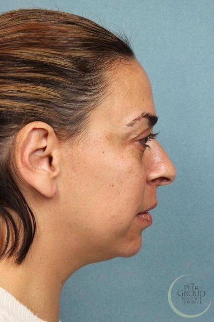 Rhinoplasty Before & After Patient #9214