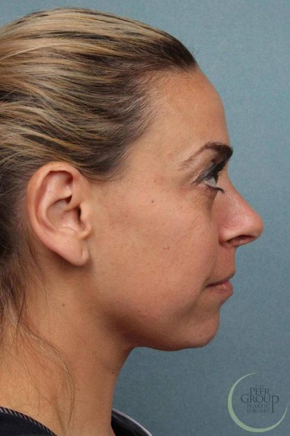 Rhinoplasty Before & After Patient #9214