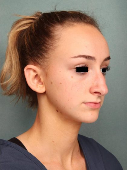 Rhinoplasty Before & After Patient #9205
