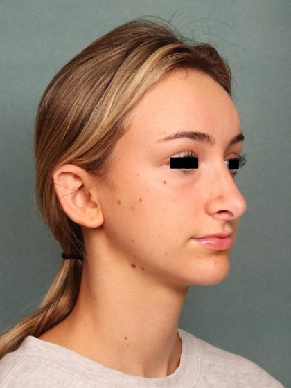 Rhinoplasty Before & After Patient #9205