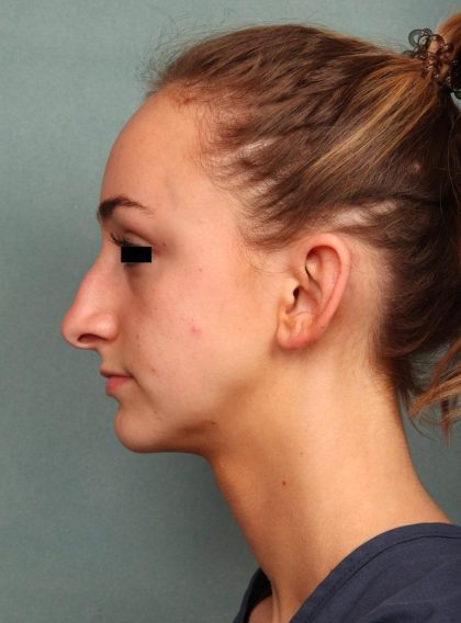 Rhinoplasty Before & After Patient #9205