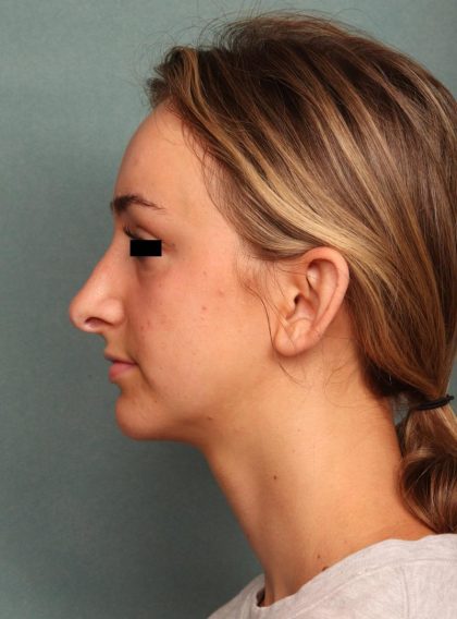 Rhinoplasty Before & After Patient #9205
