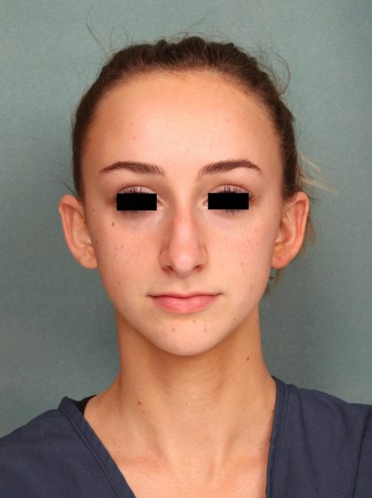 Rhinoplasty Before & After Patient #9205